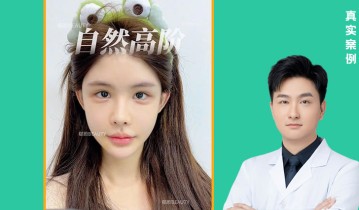 陈达医生案例【01】全脸紧致提拉，轮廓更清晰好看