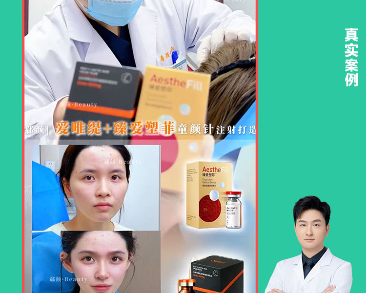 𝐃𝐫 ·陈达院长｜双童颜针 爱唯缇+臻爱塑菲✅ 胶原满格 淡纹紧致一步到位 焕启童颜肌
